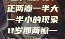 探索恢复之道，如何纠正两瓣一半大一半小的现象11岁那两瓣一半大一半小怎么恢复